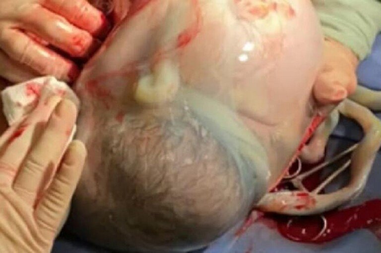 bebe nasce empelicado 1_0