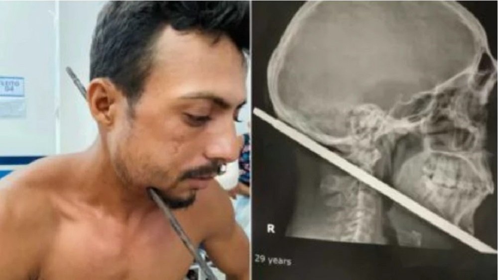 Homem sobrevive após ferro cruzar pescoço: “Sou um milagre”
