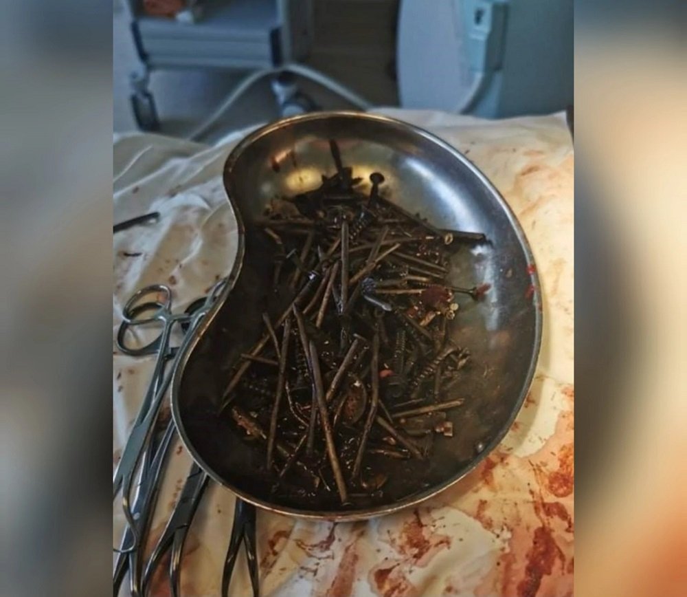 COMO ASSIM? Homem passa por cirurgia para retirada de 1 quilo de pregos e parafusos do estômago; leia e entenda