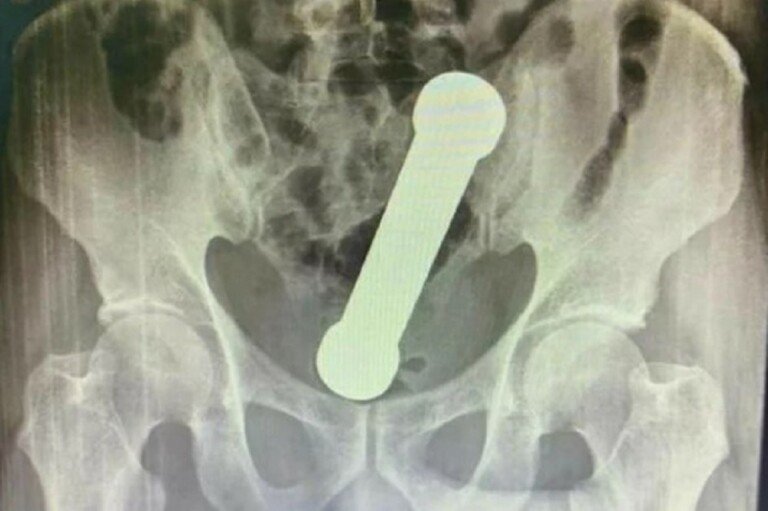 Raio-X de bacia com peso de academiaInternational Journal of Surgery Case Reports Reprodução