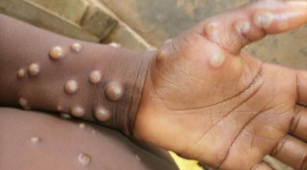 VARÍOLA DO MACACO: Rara infecção viral está se espalhando pelo mundo