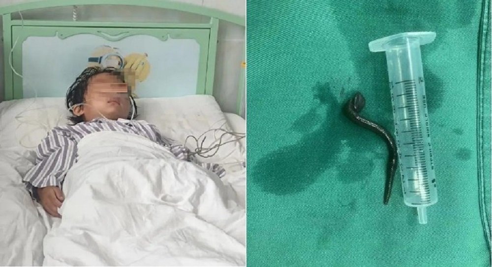 Garotinha com tosse e falta de ar tem sanguessuga removida da garganta