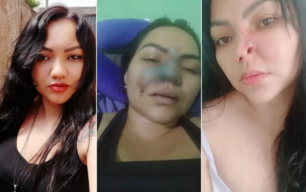 Mulher perde parte do nariz após cirurgia estética: “É assustador”