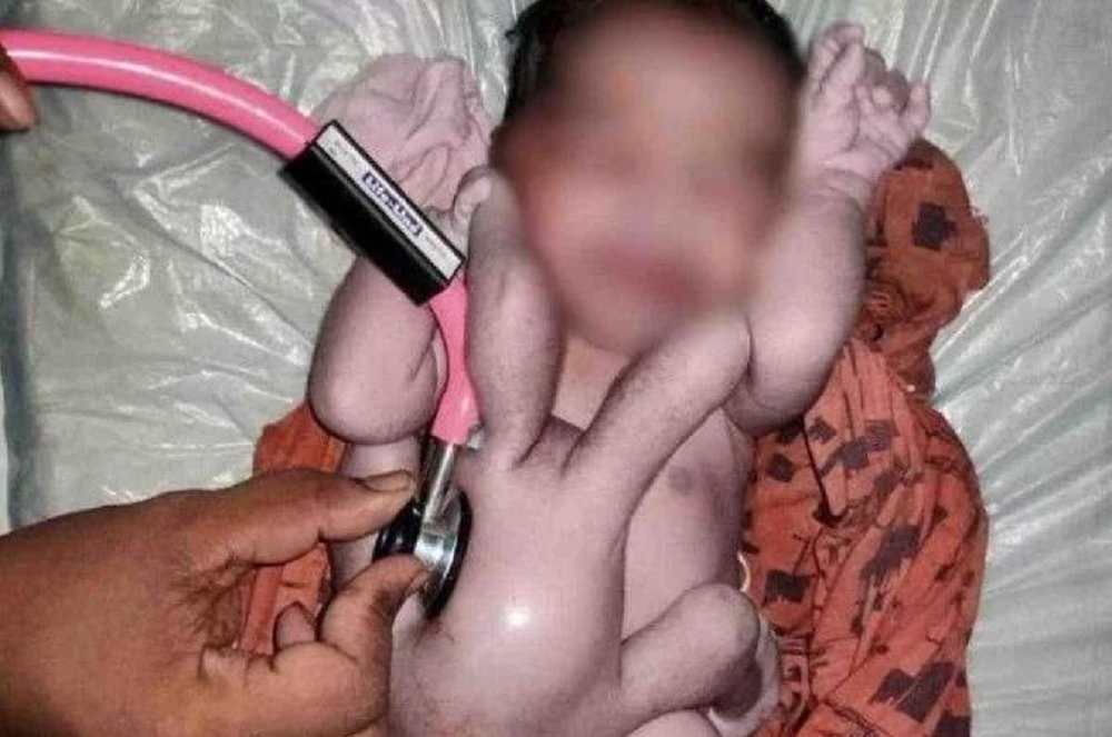 Bebê nasce com quatro braços e quatro pernas e é comparado a divindade hindu