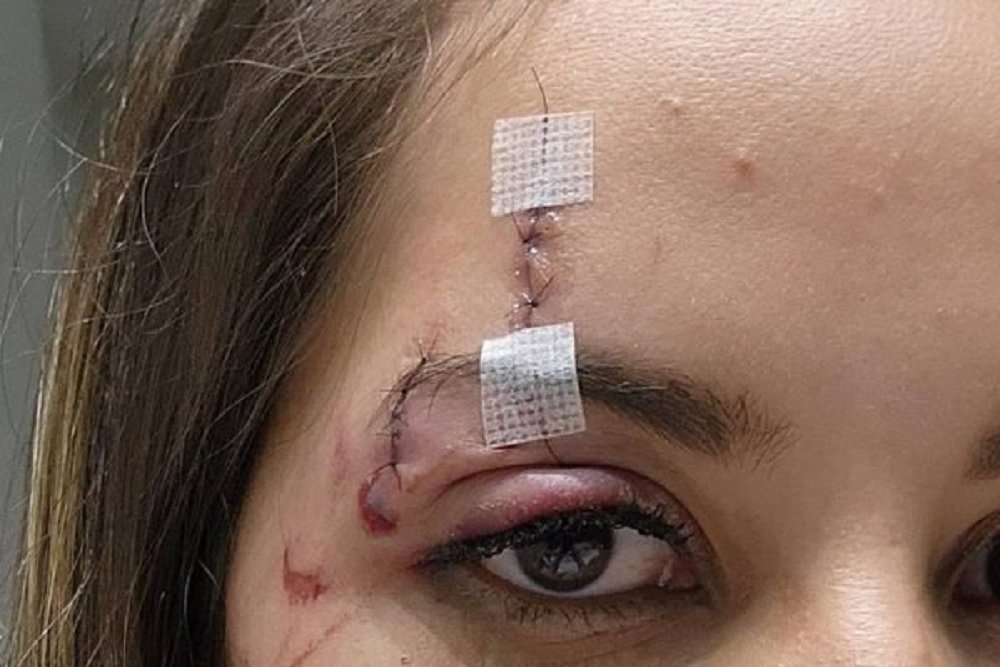 Drone atinge rosto de mulher em show de pagode no DF