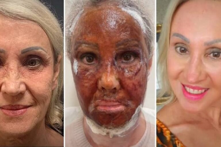 peeling-de-fenol-profundo-25102022114351782