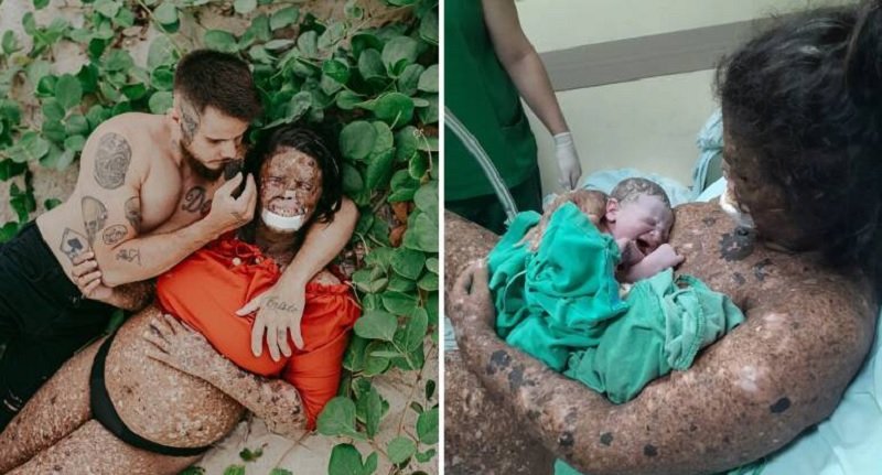 Doença rara de Pele