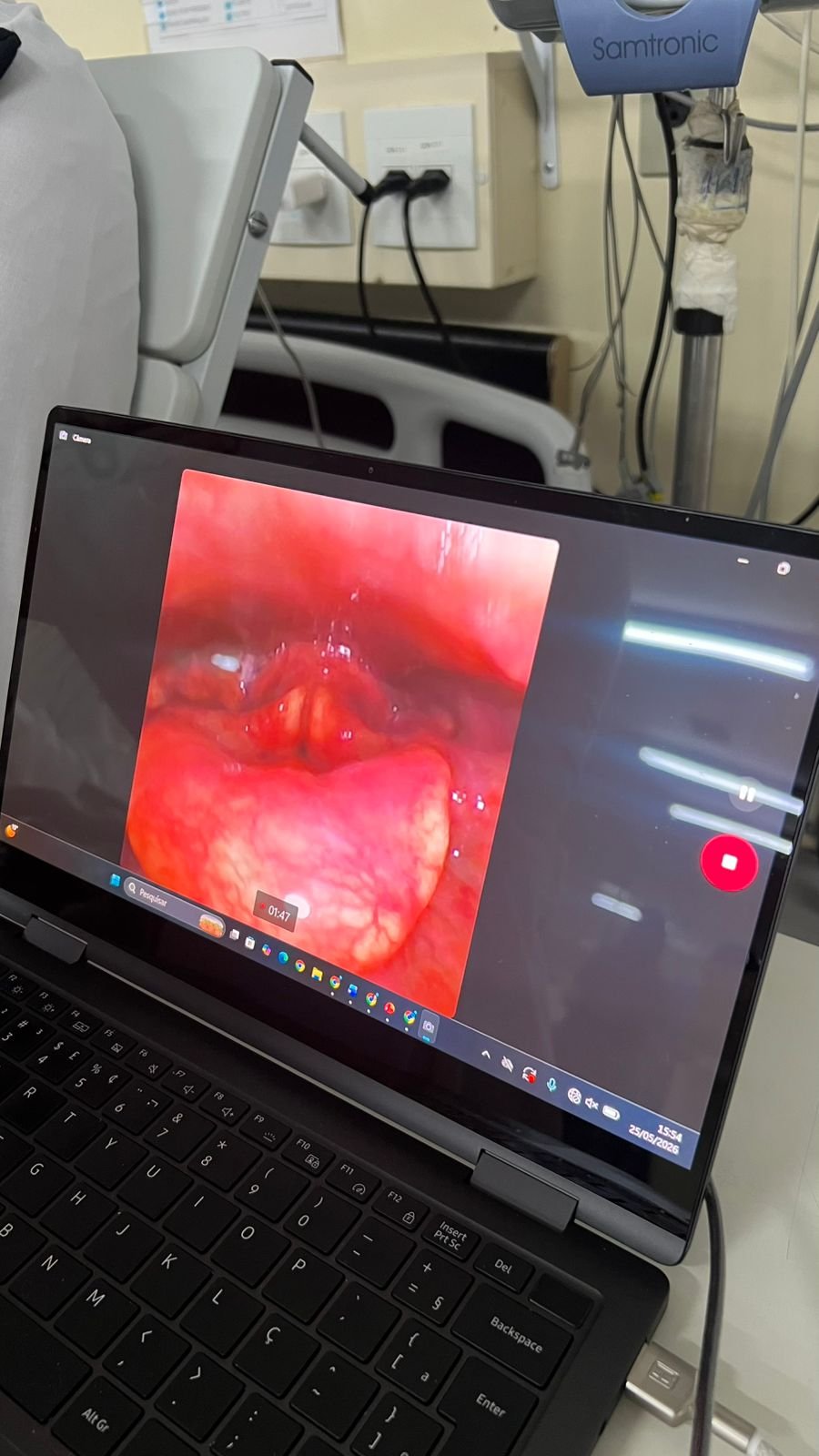 Videondoscopia-da-degluticao-avaliacao-instrumental-faringolaringea-da-seguranca-e-eficiencia-da-deg.jpeg